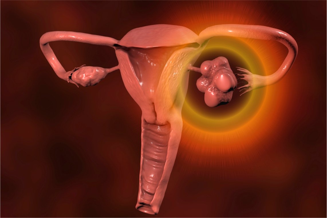 "SOP", será que você tem? - Dr. Daniel Liberman - Ginecologia e Obstetrícia
